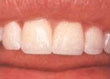 Después del composite o Veneer 