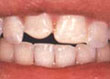 Antes del composite o Veneer 