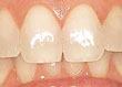 Dientes pigmentados o manchados