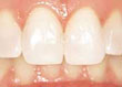 Dientes después del tratamiento de blanqueamiento