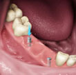Postes dentales