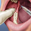 Extracción